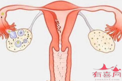 泌乳素高是多囊卵巢综合症吗