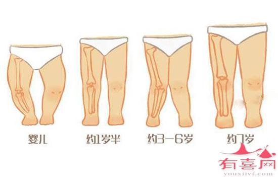 外胚层发育不良症症状