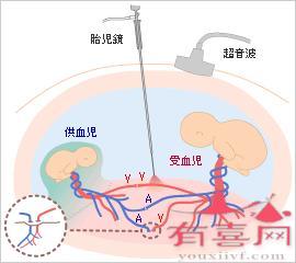 双胞胎输血综合征症状