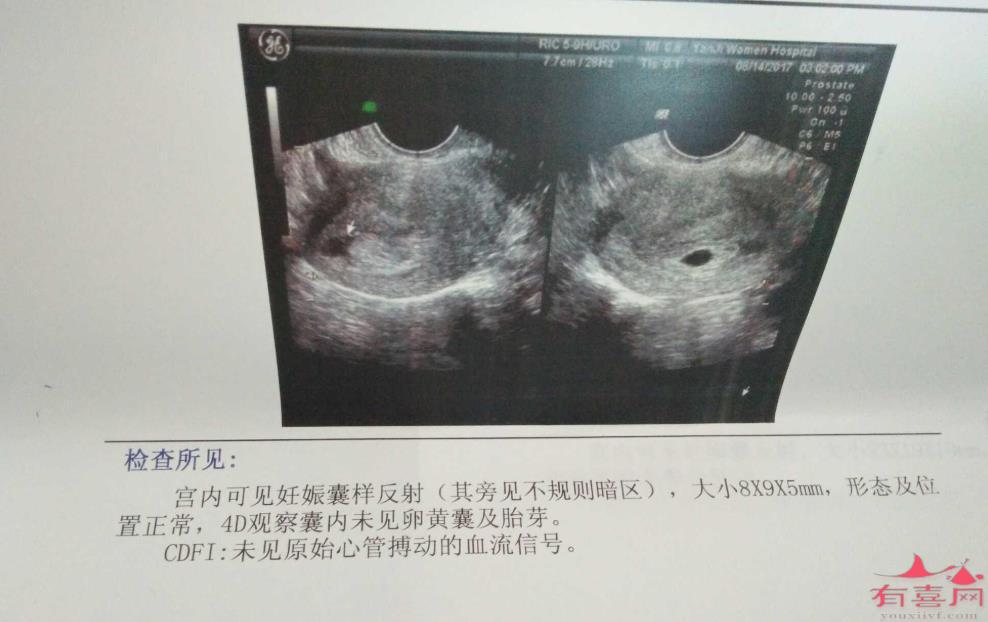 怀孕空囊是什么意思