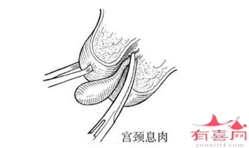 宫颈息肉会导致不孕吗