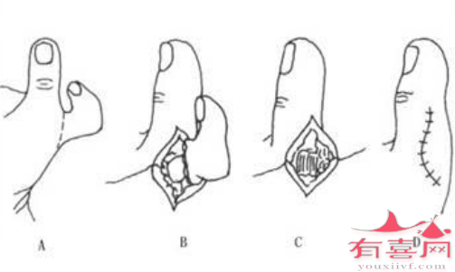 修复关节囊的多指切除术