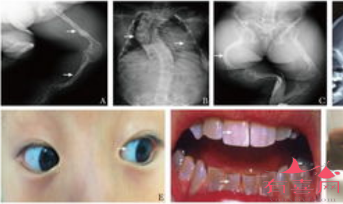 成骨不全症临床表现示意图