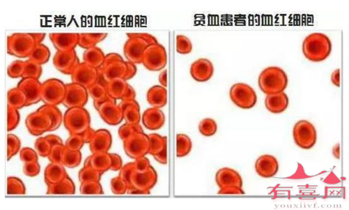 β珠蛋白生成障碍性贫血