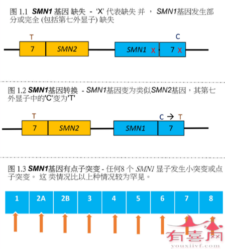 SMN1基因有点子突变