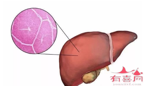 肝豆状核变性导致肝脏异常