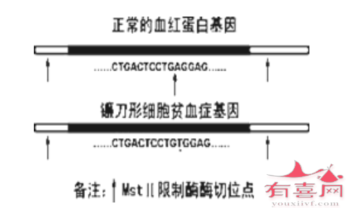 镰状细胞贫血病因