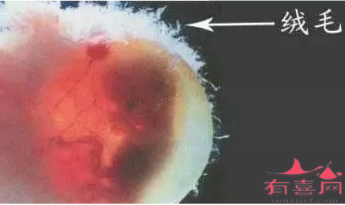 绒毛膜绒毛取样