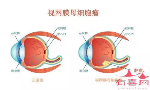 视网膜母细胞瘤