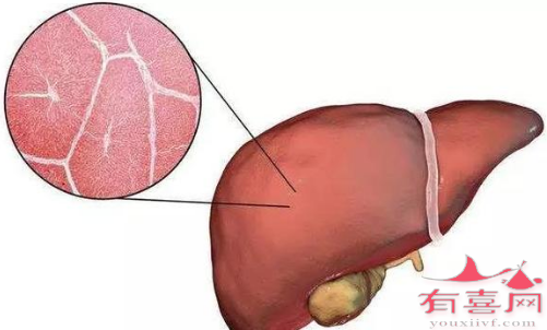 肝豆状核变性是什么