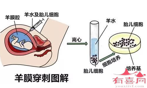 羊膜穿刺检测过程示意图