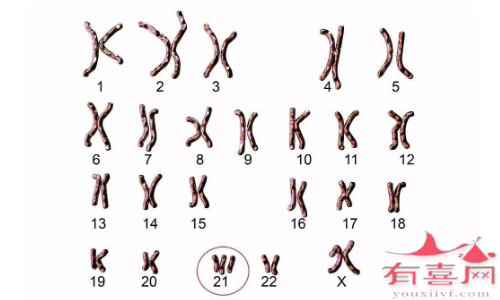 特纳氏综合征不同类型与染色体有关