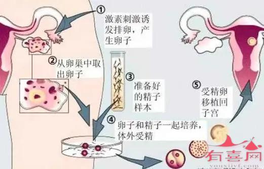 试管婴儿流程示例图