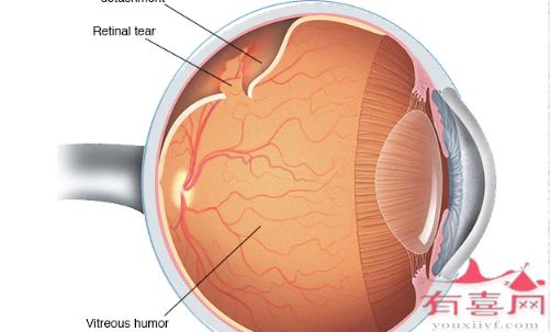 视网膜脱落