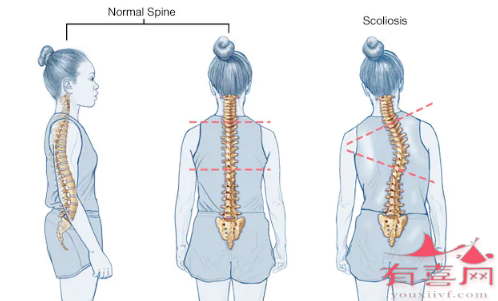脊柱侧弯