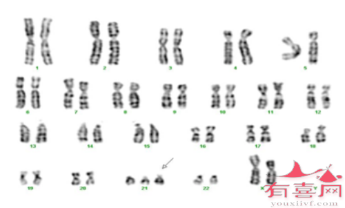 21号染色体数目或结构异常导致