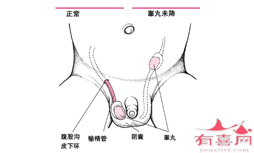 睾丸未降