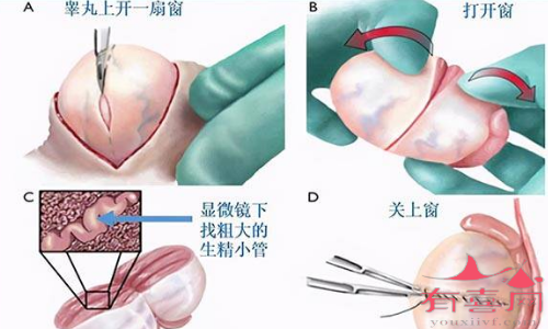 睾丸显微取精示意图