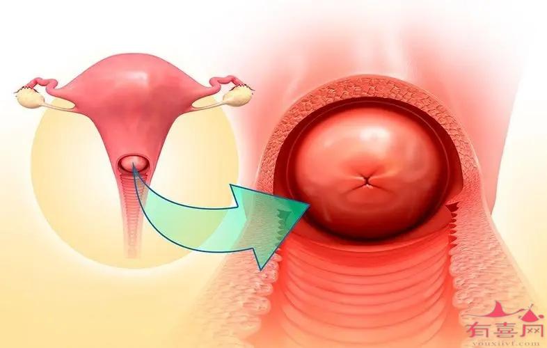 宫颈肥大的恢复治疗法你知道几个