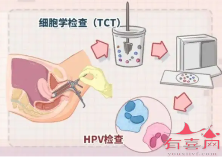 宫颈癌筛查项目