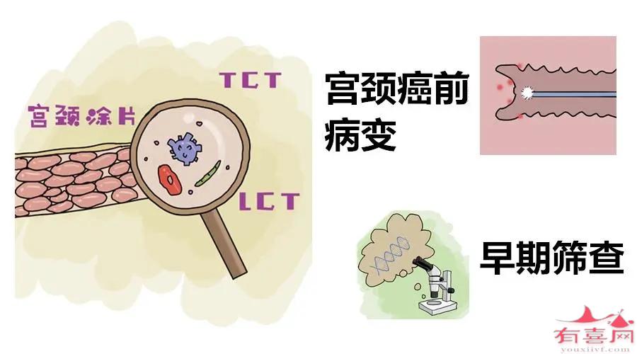 宫颈癌前病变的五大症状