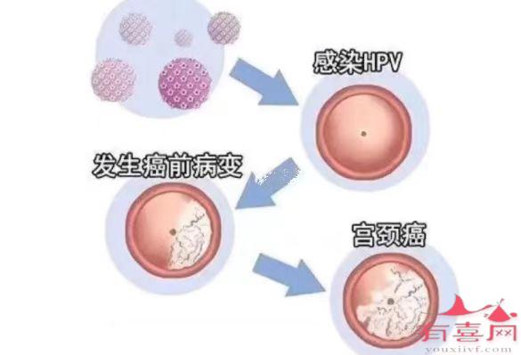 宫颈癌性病变通常是由HPV感染引起