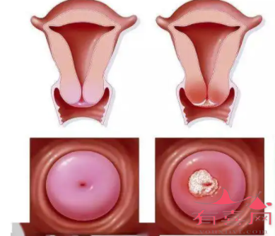 宫颈糜烂如何根治的三大方法