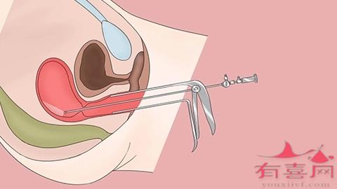 扩张宫颈及搔刮术