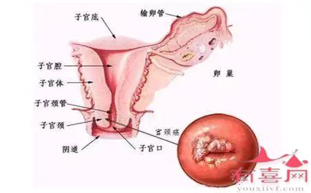 宫颈腺囊肿是什么引起的