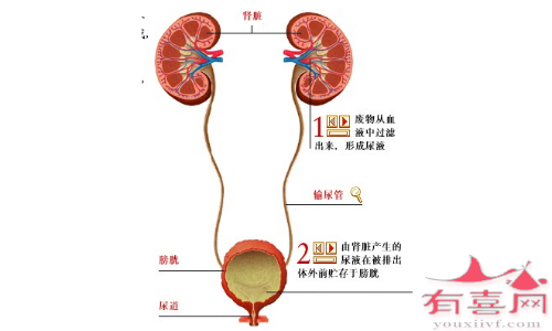 进行高尿钙治疗