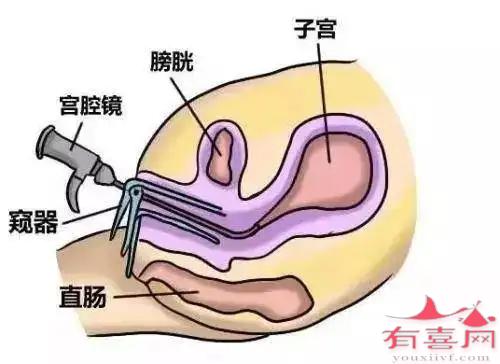 宫腔镜下插管通液术