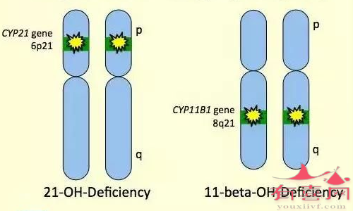 21-羟化酶缺乏症概述