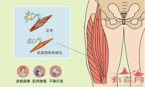 什么是肌萎缩侧索硬化症