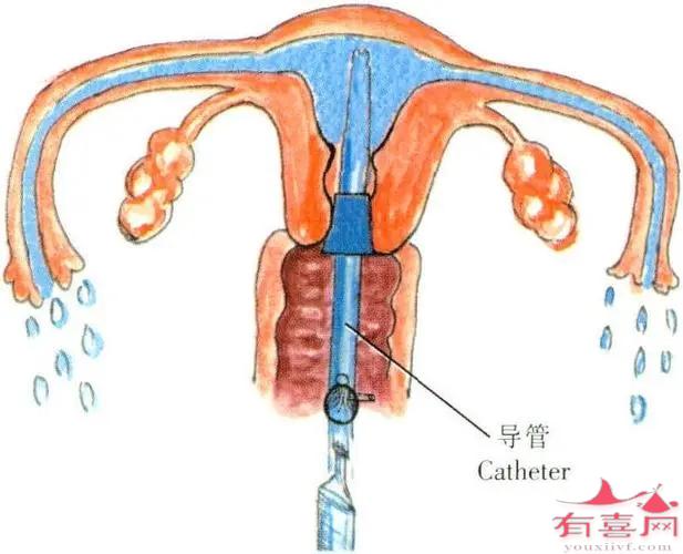 输卵管通液手术示例图