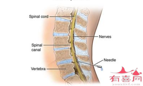脊髓穿刺示意图