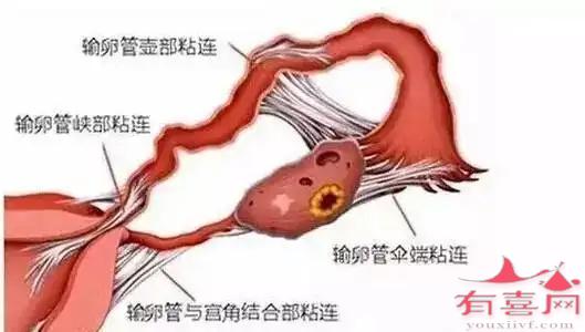 输卵管粘连严重可致不孕，是什么原因引起的