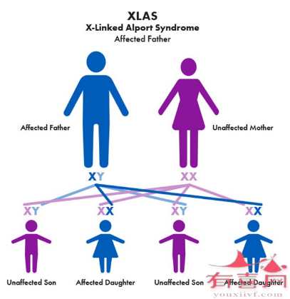 Alport综合征X连锁隐性遗传