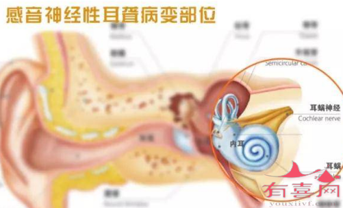 感音神经性耳聋