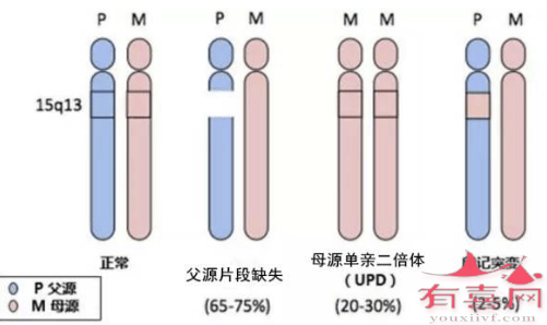 天使综合征具有遗传性