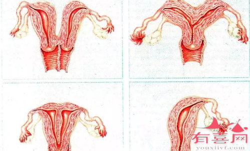 子宫因素导致不孕