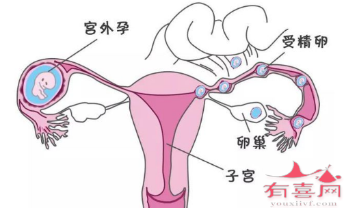 宫外孕有哪些症状表现