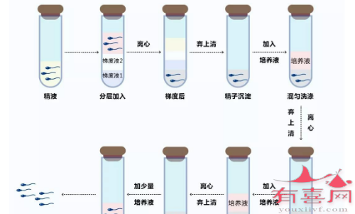 洗涤精子技术.png