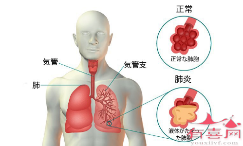 肺炎症状反复发作