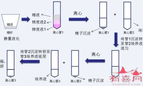 三代试管婴儿+洗精术解决男性 感染生育问题