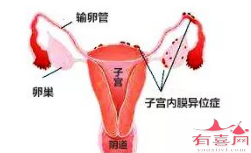 可能导致子宫内膜异位症的原因