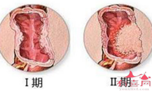 早期大肠癌治愈率高