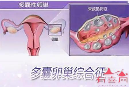 关于多囊卵巢的治疗方法