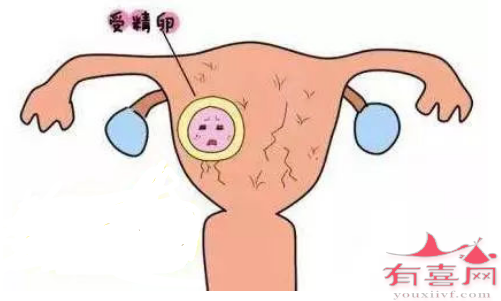 子宫腺肌症如何影响怀孕