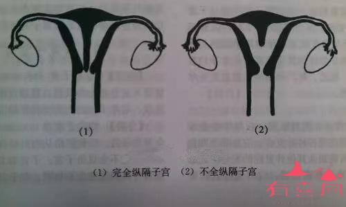 纵隔子宫分为完全纵隔子宫和不完全纵隔子宫