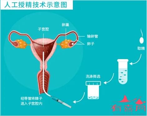 人工授精技术示意图